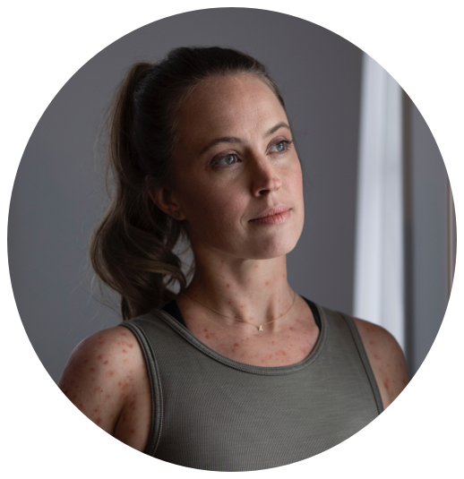 White Woman in Tank Top Showing Skin Rash