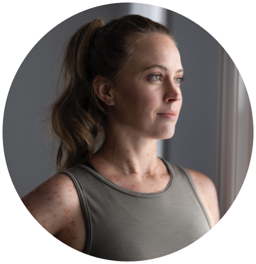 White Woman in Tank Top Showing Skin Rash And Looking Out Window